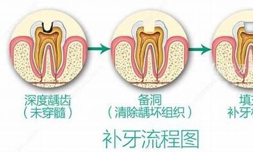 日本可乐丽树脂补牙-日本可乐树脂补牙好吗